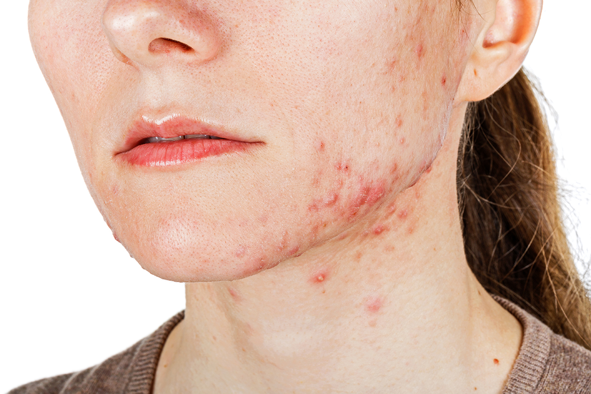 Skin problem, acne | Integrated Health Clinic